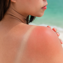 Предпазване от слънчево изгаряне