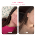 acne out активен лосион дава отлични резултати против пъпки