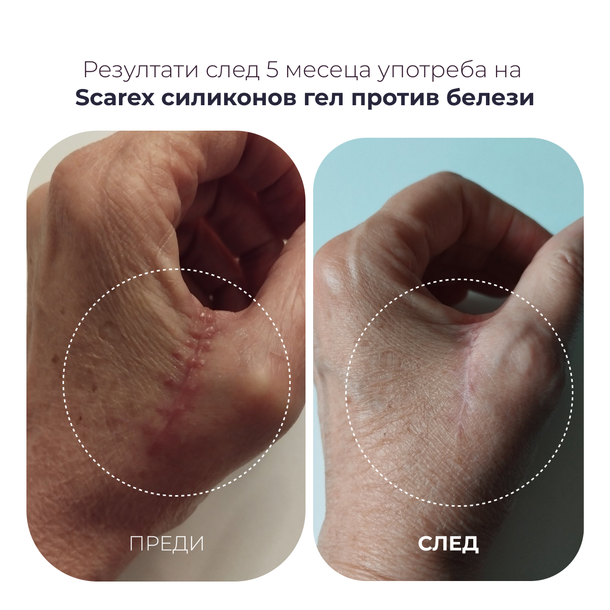 Scarex силиконов гел против белези мини