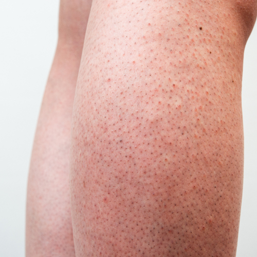 Какво е ягодова кожа на краката и как да се справим с нея?